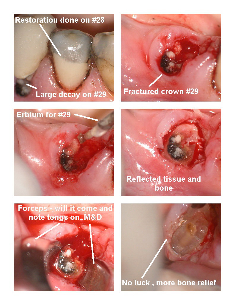 Osseous on extraction premolar pg 1.jpg